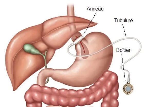 anneau gastrique Paris