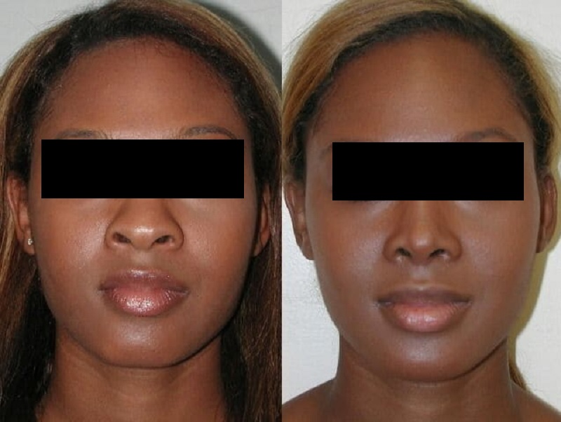 chirurgie esthétique nez africain Paris