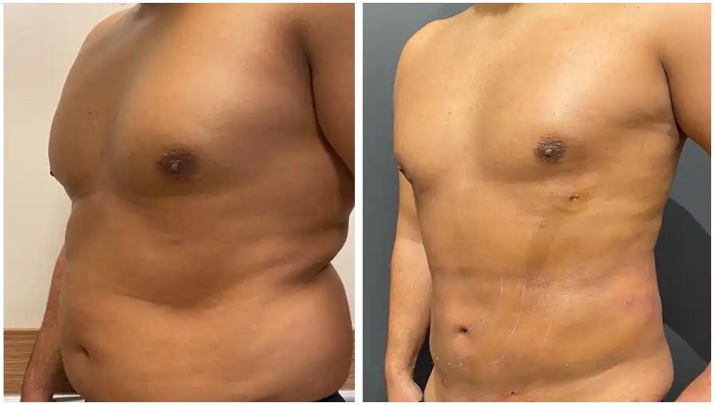 lipoaspiration abdominale Paris