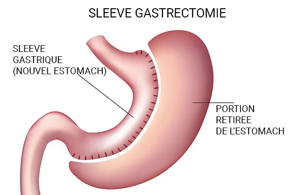 sleeve gastrectomie