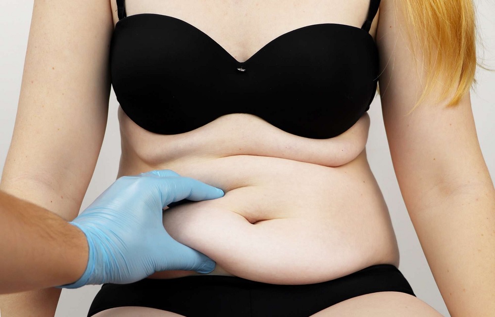 transposition ombilicale avec abdominoplastie